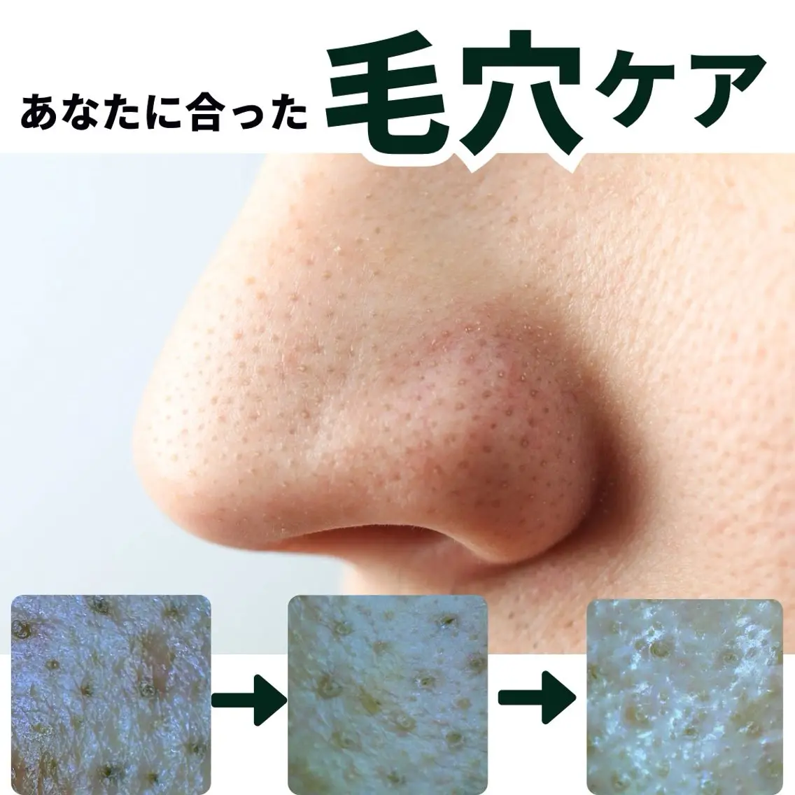 黒ずみ毛穴　角栓詰まりにお悩みの方　自宅ケアセット付き　毛穴をキュッとしめるスペシャルケアの写真