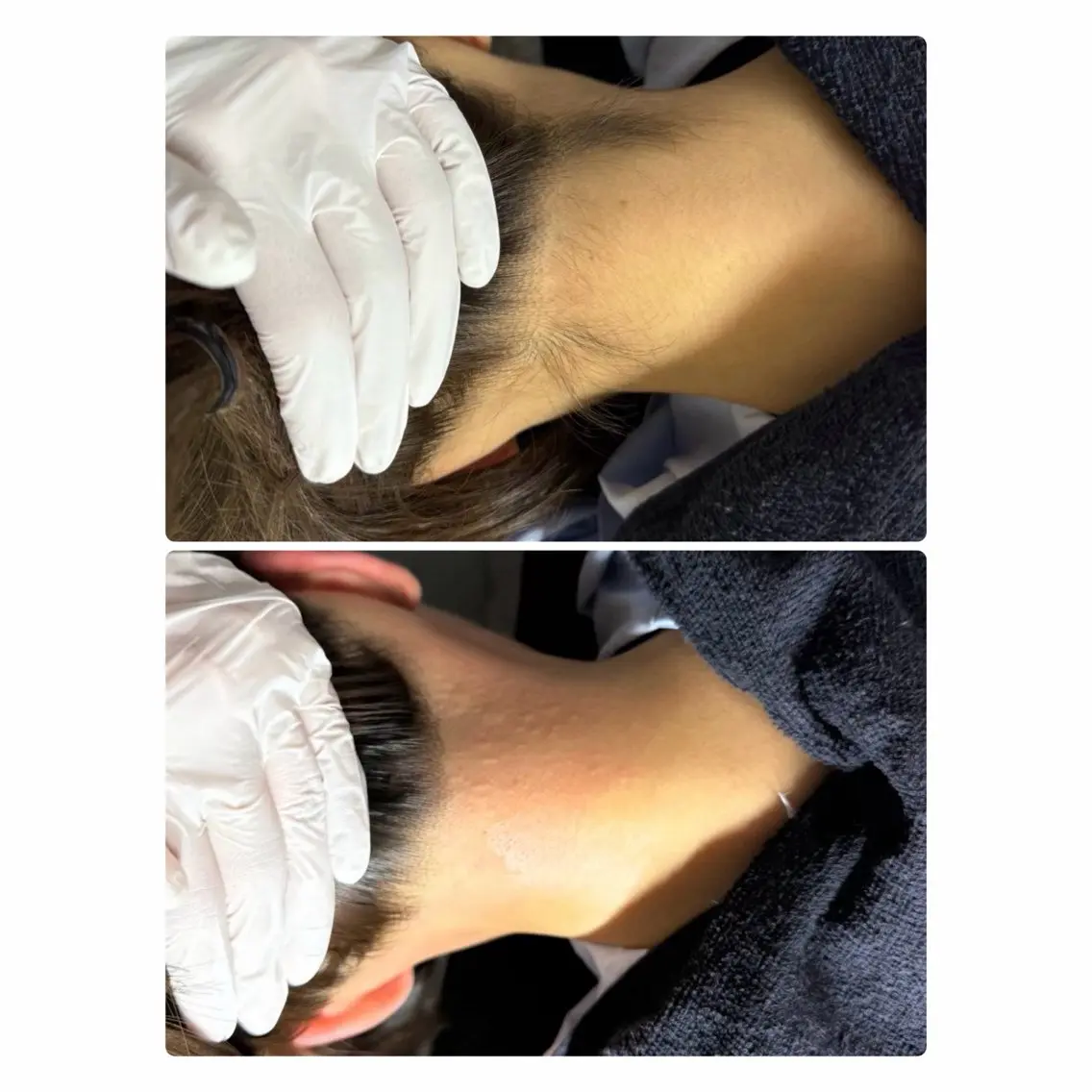 うなじワックス脱毛の写真