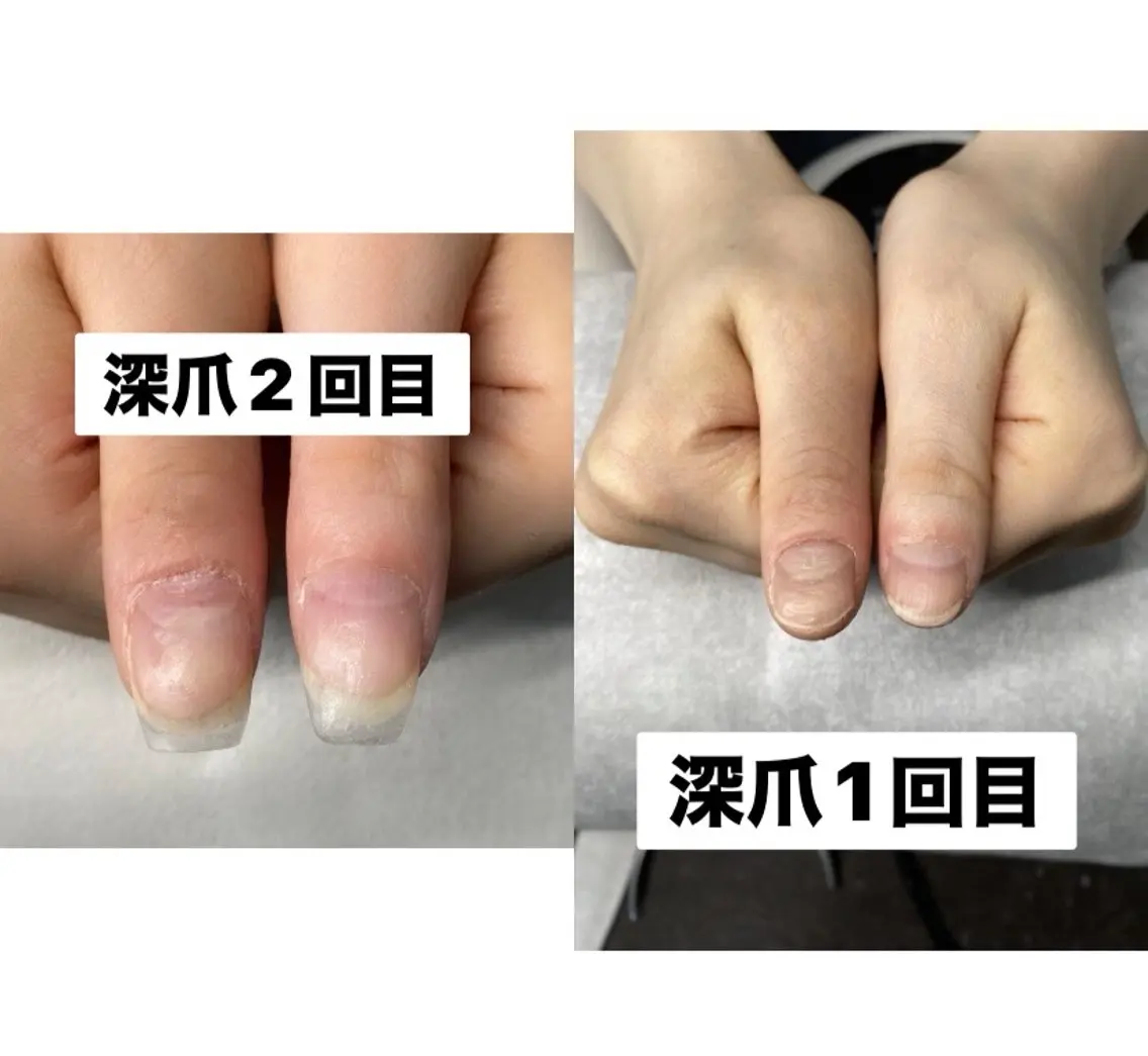 深爪矯正【3回でお得️○】即日長さだし有り/深爪・歪んだ爪を縦長の美爪に育成💪1回辺り¥8,000🉐/カラー追加別途の写真