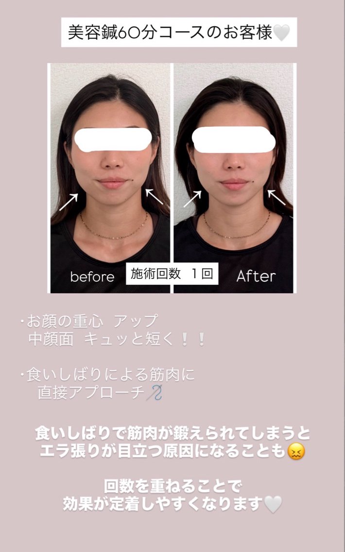 エステ リラク 益吉 未来音 美容鍼/ 首肩こりのエステ・リラクイメージ