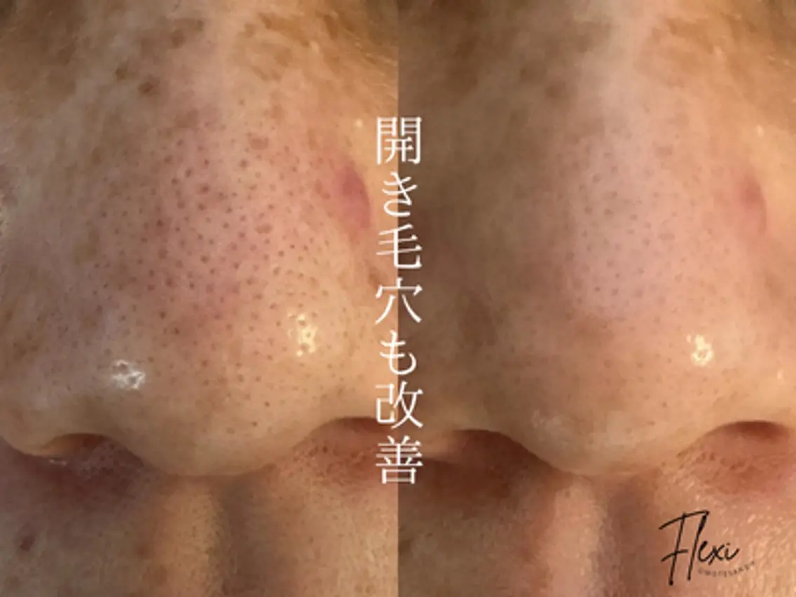 【いちご鼻・ザラつき卒業】毛穴詰まり解消ピーリングコースの写真