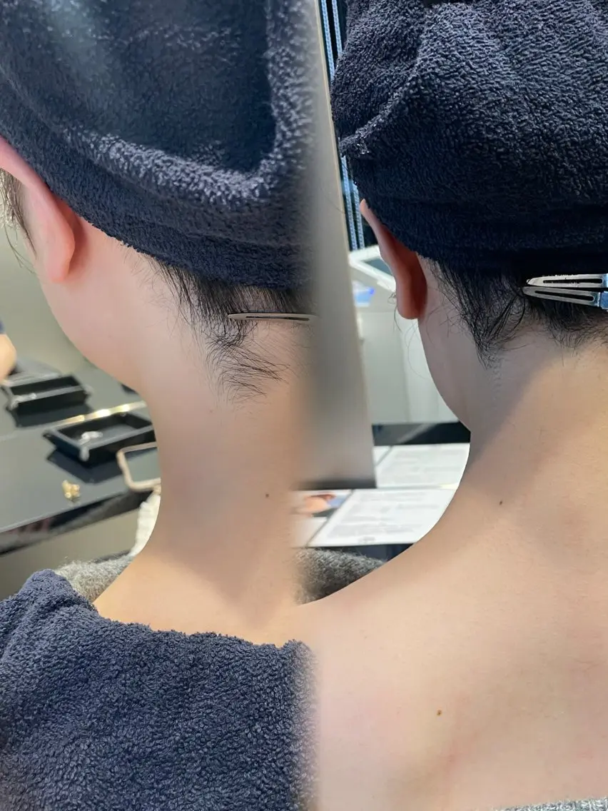 【うなじ脱毛】美容室だからできる✨うなじの形をデザインし脱毛します🌻頭皮クレンジングシャンプーブロー無料🤍🫧の写真