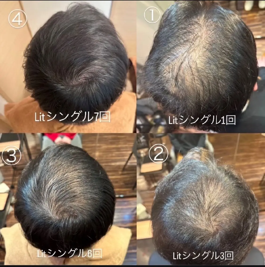 【薄毛でお悩み】最先端の幹細胞技術　エイジング×育毛の写真