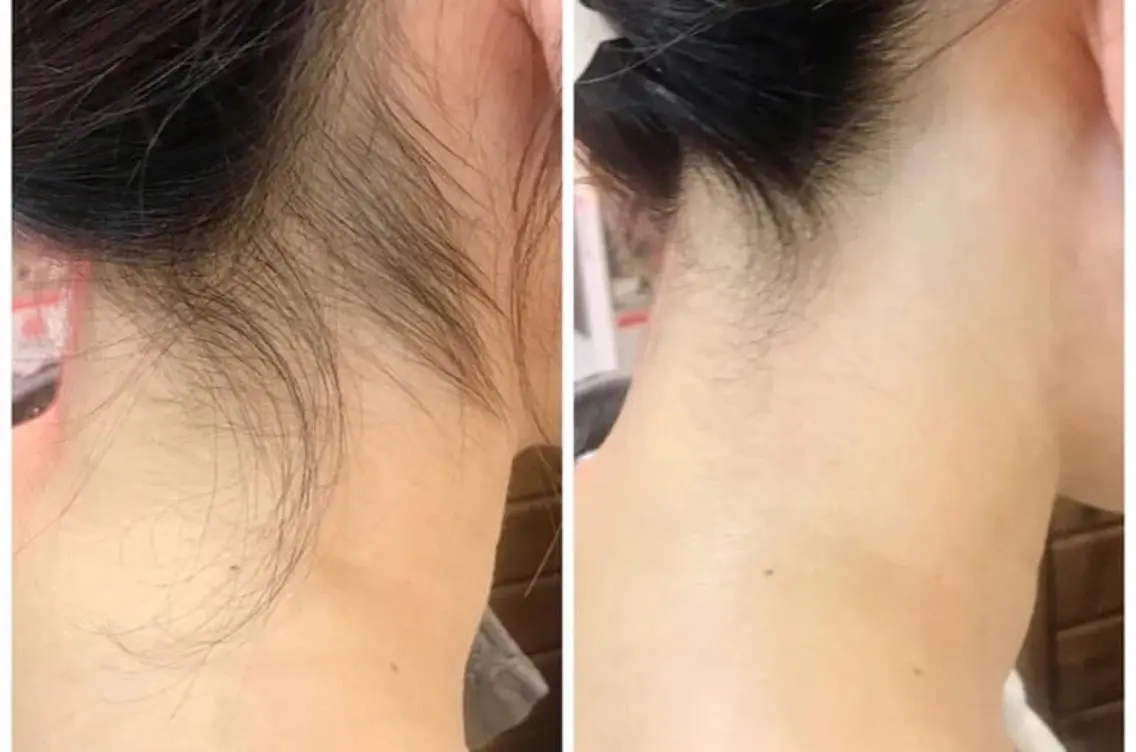 うなじ・背中脱毛🌱見えない箇所も美しく🎀の写真
