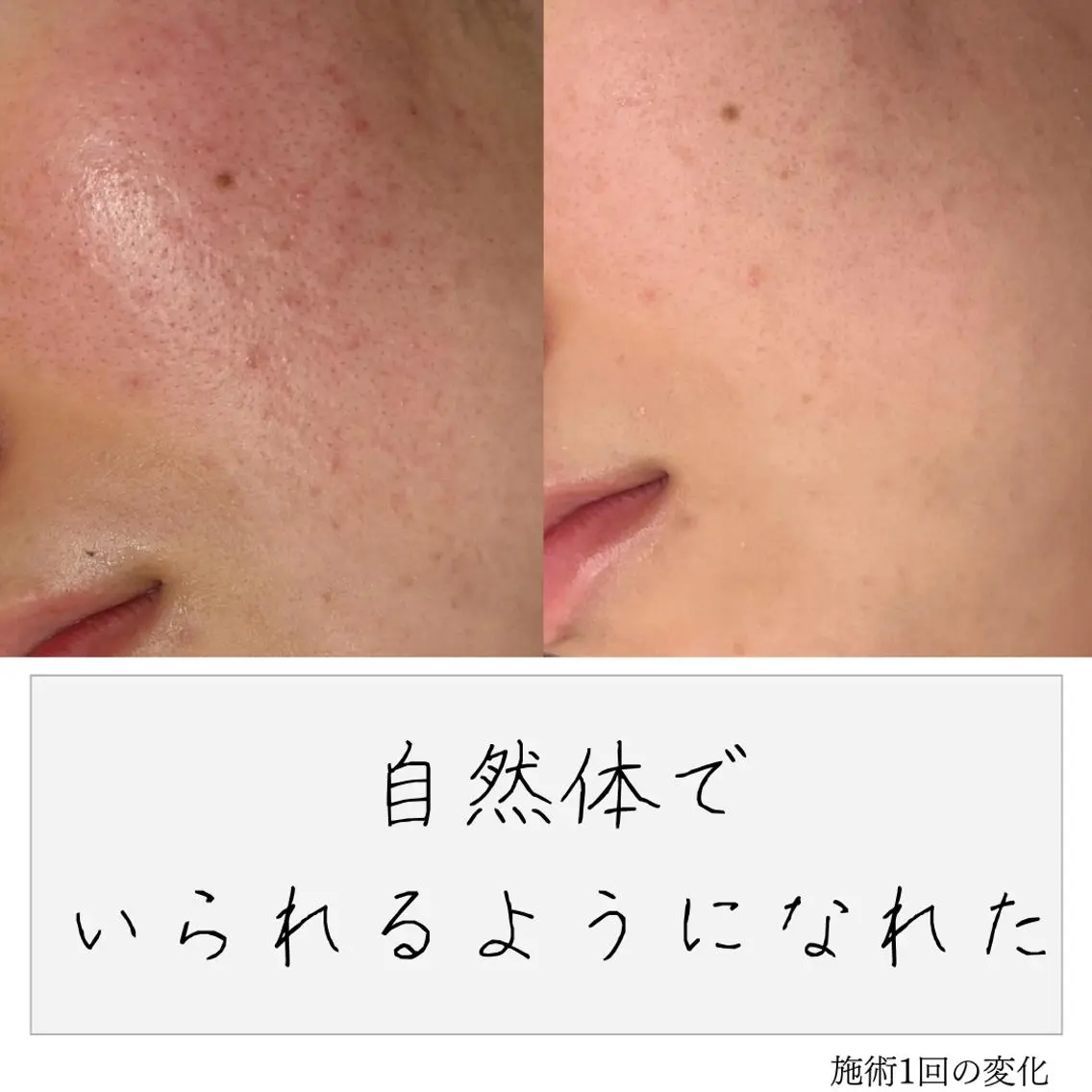 ニキビ経験者が施術 する専門サロン🌻のエステ・リラクイメージ