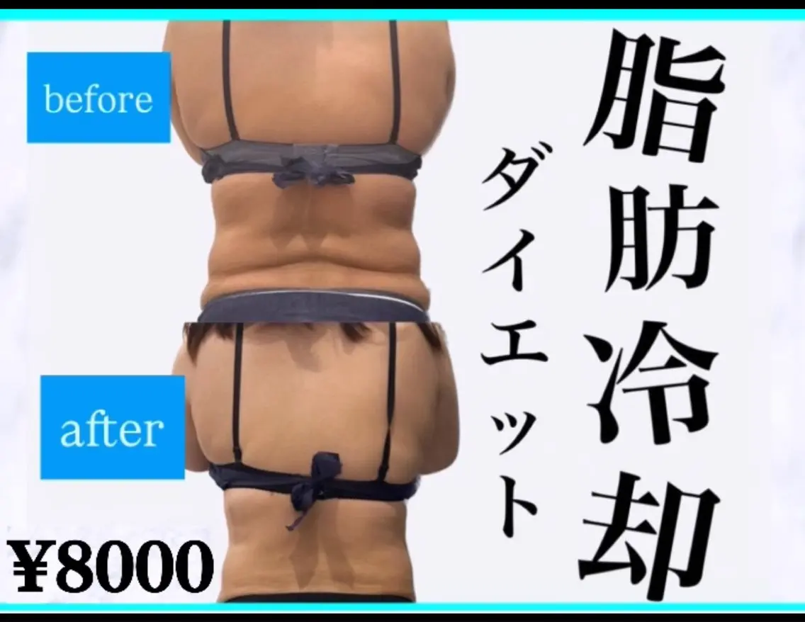 話題の冷却ダイエット💎その脂肪落とせます!冷却2カップ+EX痩身90分ミニモ価格💎の写真