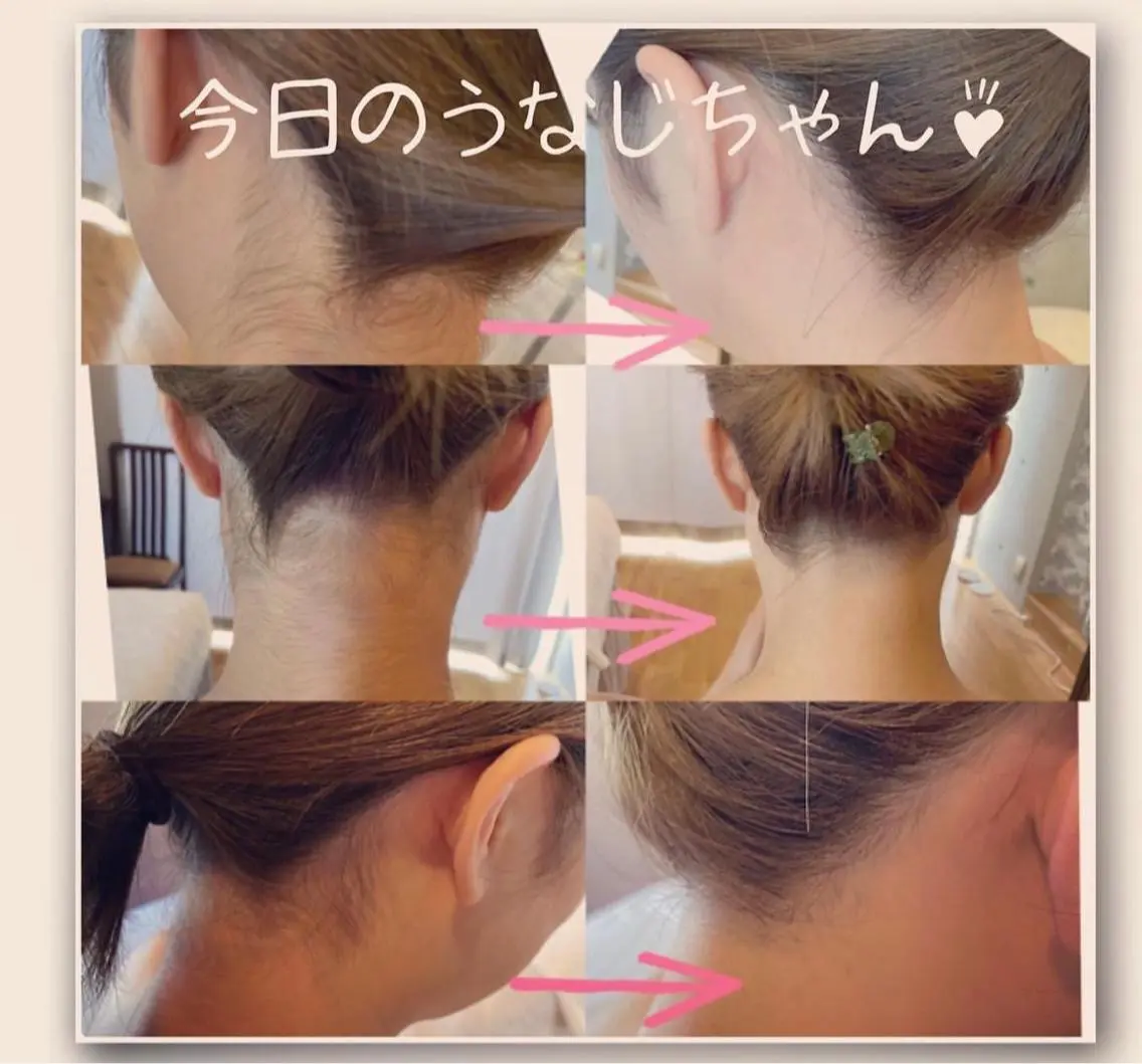 うなじ脱毛の写真