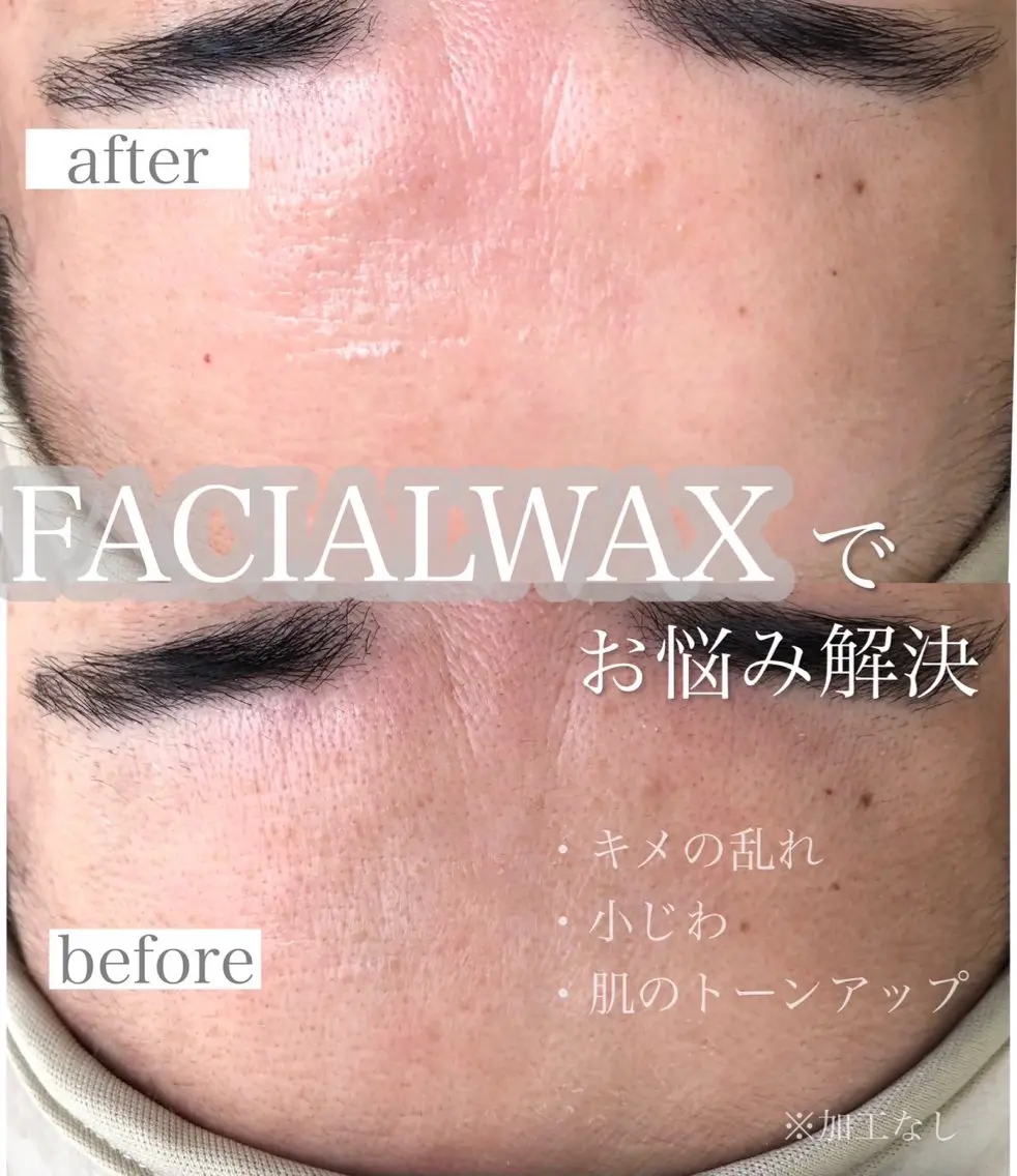 ✨新メニュー導入✨フェイスワックス脱毛［モニター価格］の写真