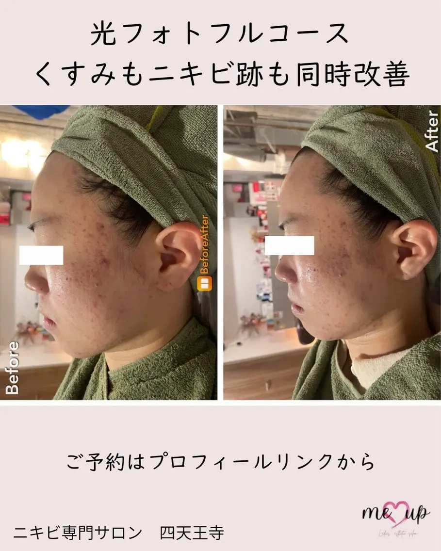 エステ Meupニキビ専門店 背中/ハーブ/肌管理のその他イメージ