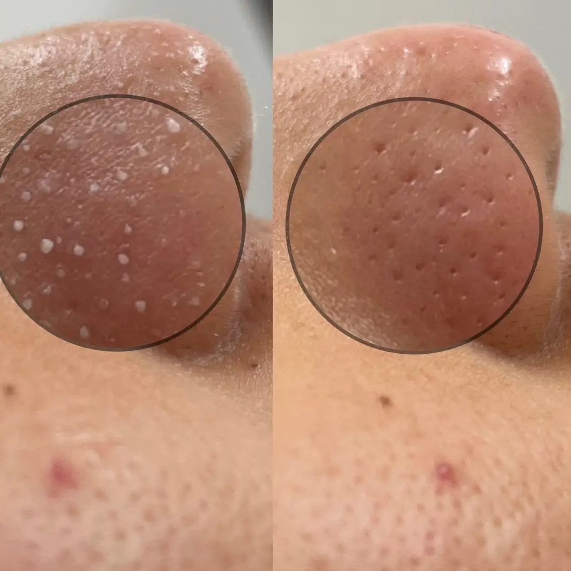 特別価格✨【皮脂分泌の増える季節】いちご鼻とさよなら👃🍓小鼻美人へ✨の写真