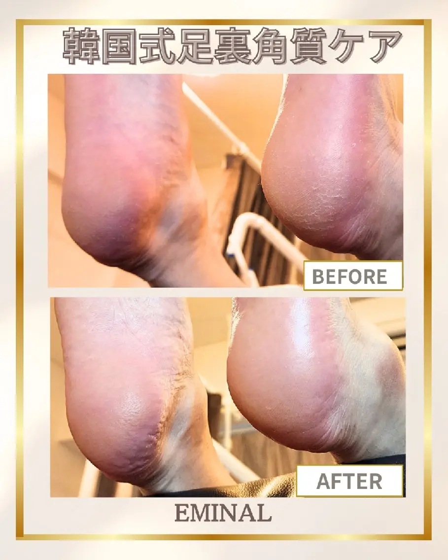 新規:足裏角質ケアスタンダードコースの写真