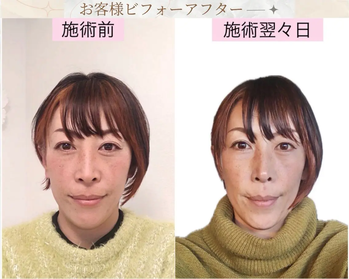 リフトアップ小顔矯正 いまいあやののその他イメージ