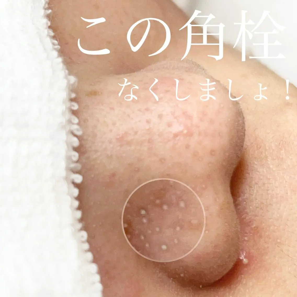 【 天然の水光肌になれる】本格ラボーテ式毛穴エクストラクションプロの写真