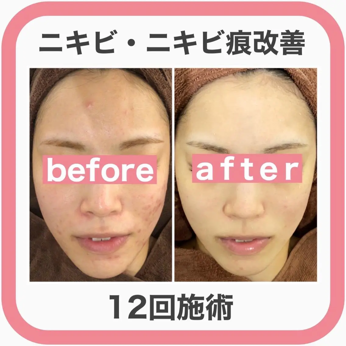 セミロング カラー パーマ ヘアアレンジ メンズ キッズ ネイル マツエク・マツパ アイブロウ エステ リラク 3か月で肌革命👼 ニキビ専門店💫のエステ・リラクイメージ