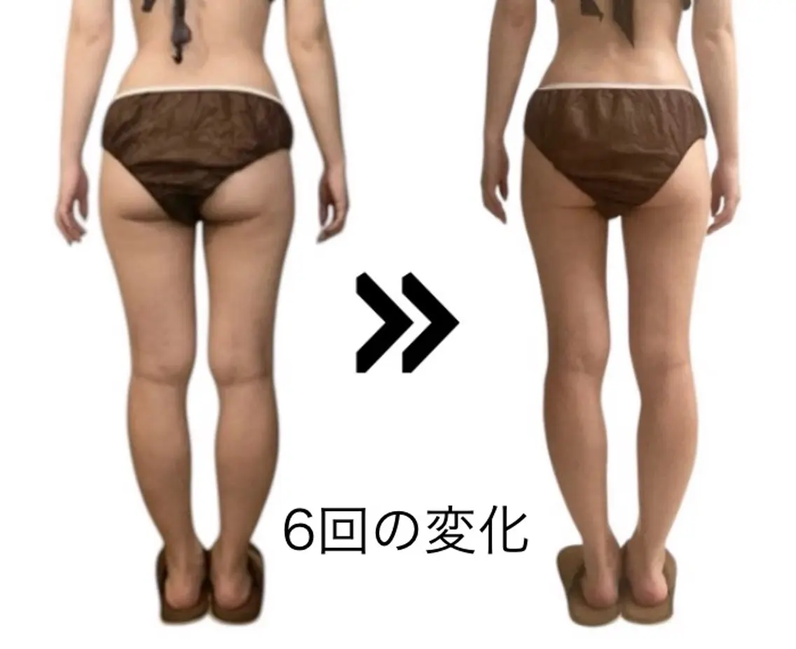 【半身徹底シェイプ】ラジオ波集中60分痩身クリーム使用上半身or下半身を本気引き締め🔥の写真