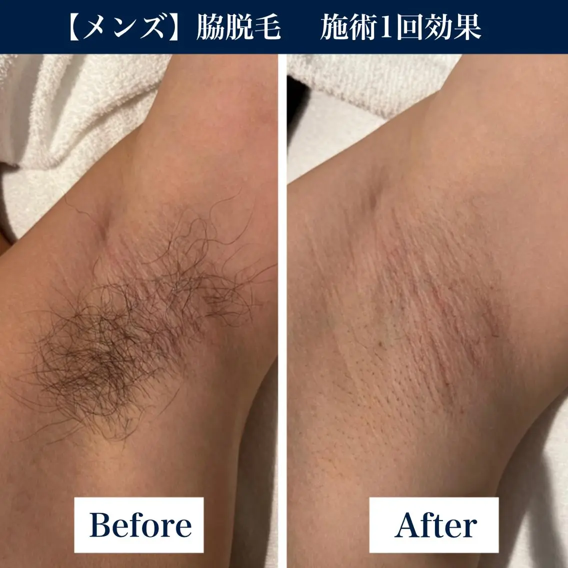 【メンズ脱毛】 脇脱毛 ¥1,980-の写真