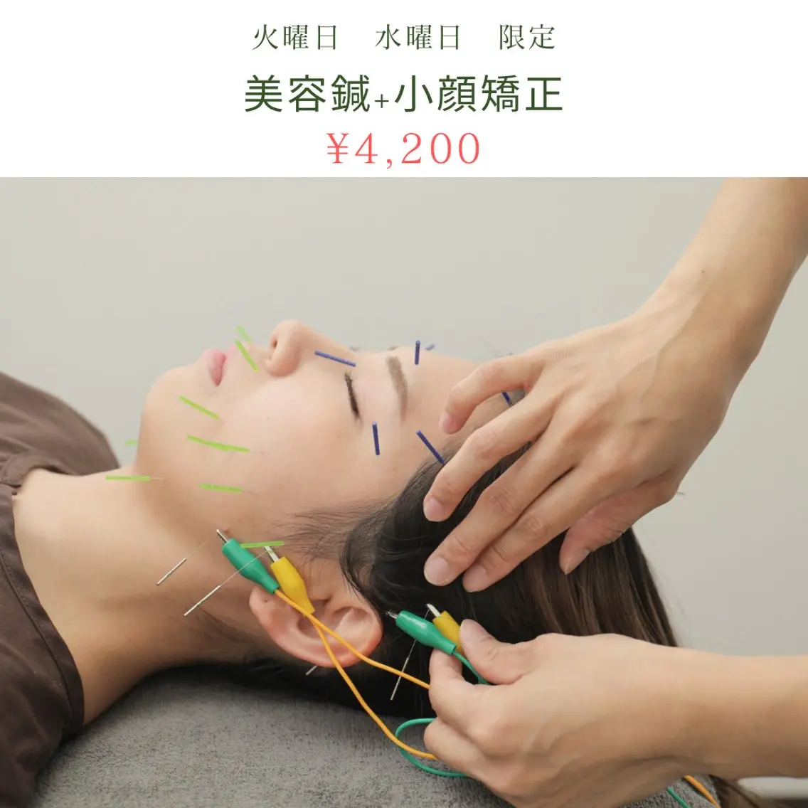 ☘️火・水限定🌱美容鍼＋小顔矯正＋ドライヘッドスパ（60分）の写真