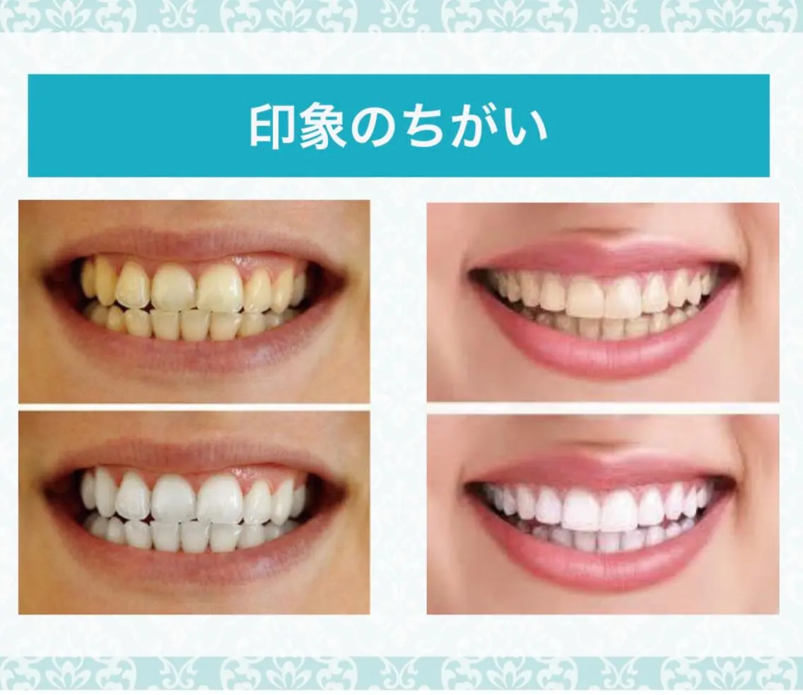 セルフホワイトニングの写真