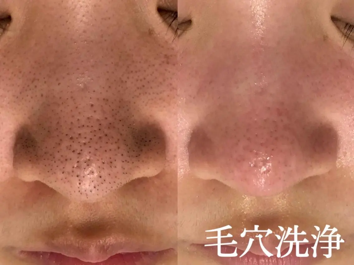【新規/花粉や皮脂対策で透明肌へ】全顔3D毛穴洗浄¥5500の写真
