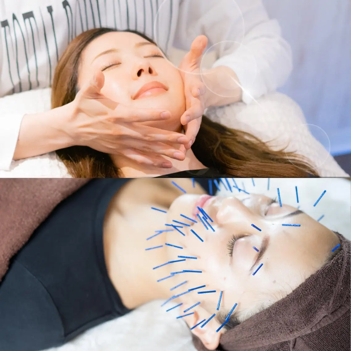 【人気No.1 小顔×肌改善 】初回70%off《美容鍼/美顔鍼×小顔矯正/75分/18,000→5,500円》の写真