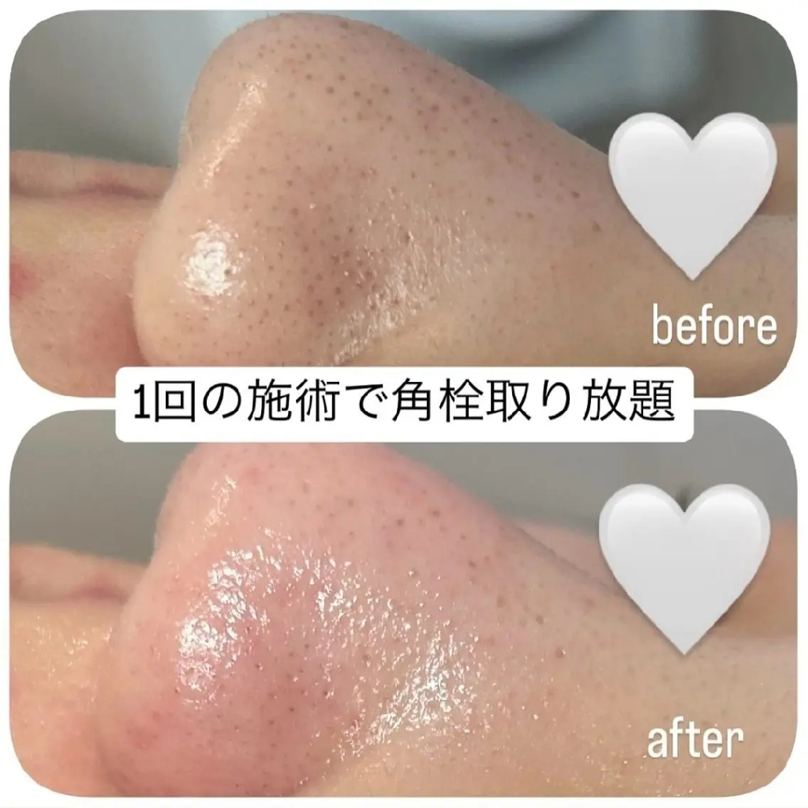 【先行特別価格】話題の毛穴最強トリートメント💆毛穴エクストラクションモニター ¥14,700→¥8,800の写真