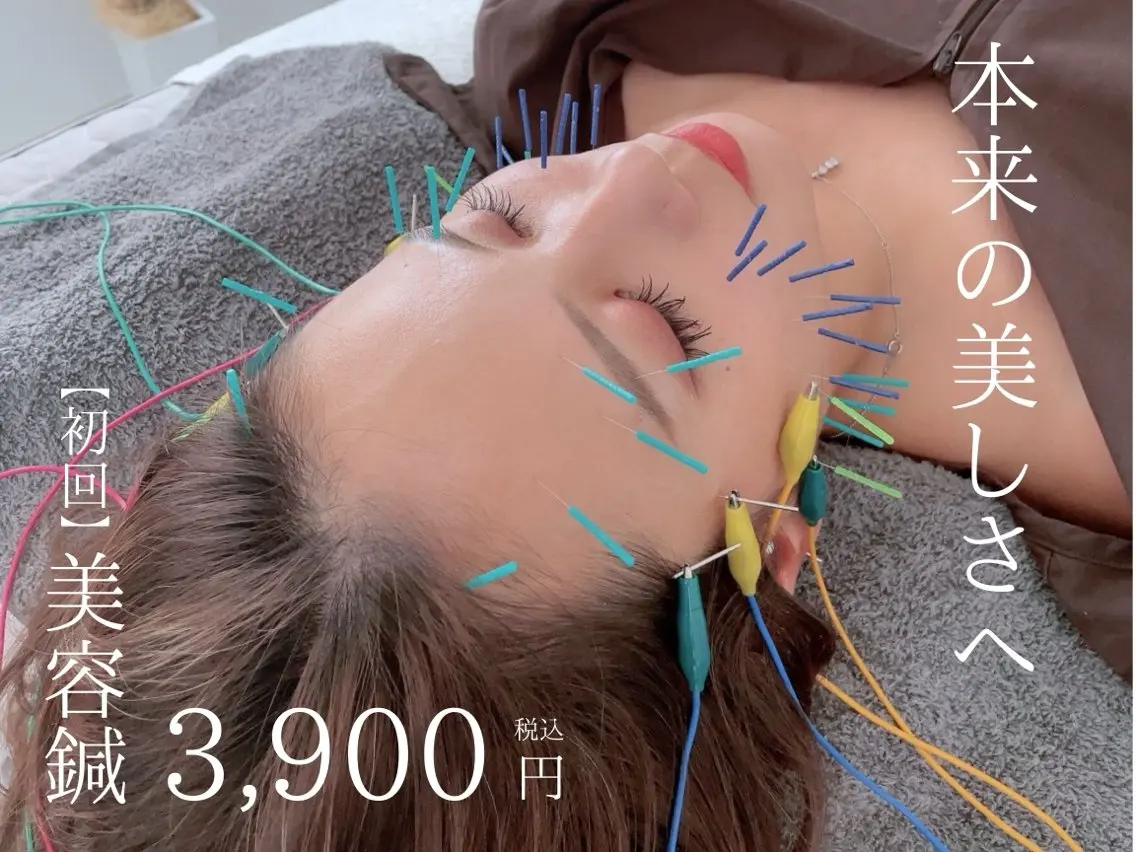 【初回65%OFF】トライアル美容鍼✨むくみやたるみもスッキリ‼️眼精疲労にも◎の写真