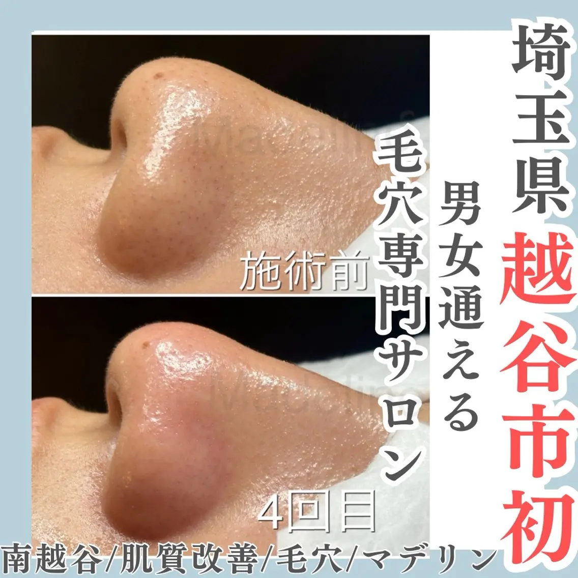 【エステ人気No.1】何をしても取れなかった鼻の黒ずみ/ざらつき/毛穴開き/毛穴洗浄/毛穴エクストラクションプロ80分の写真