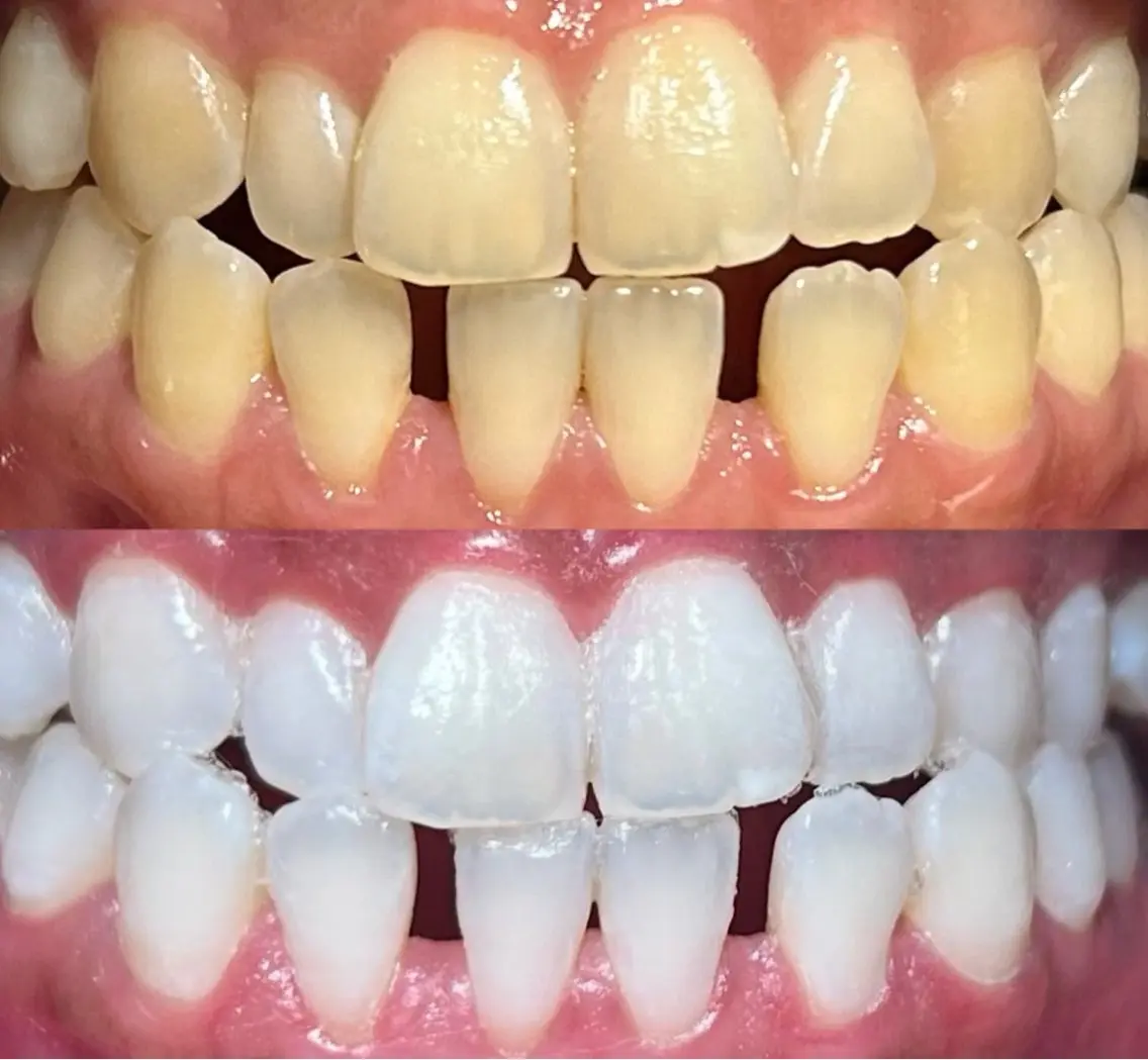 io teeth careのその他イメージ