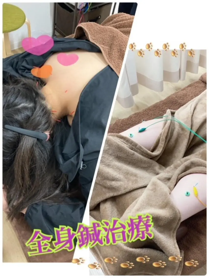 【新規限定】【5月限定価格】🌸全身鍼(慢性痛・女性特有の悩み)(+500円で箱灸追加可能✨)の写真