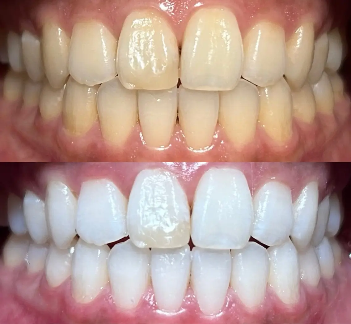 io teeth careのその他イメージ