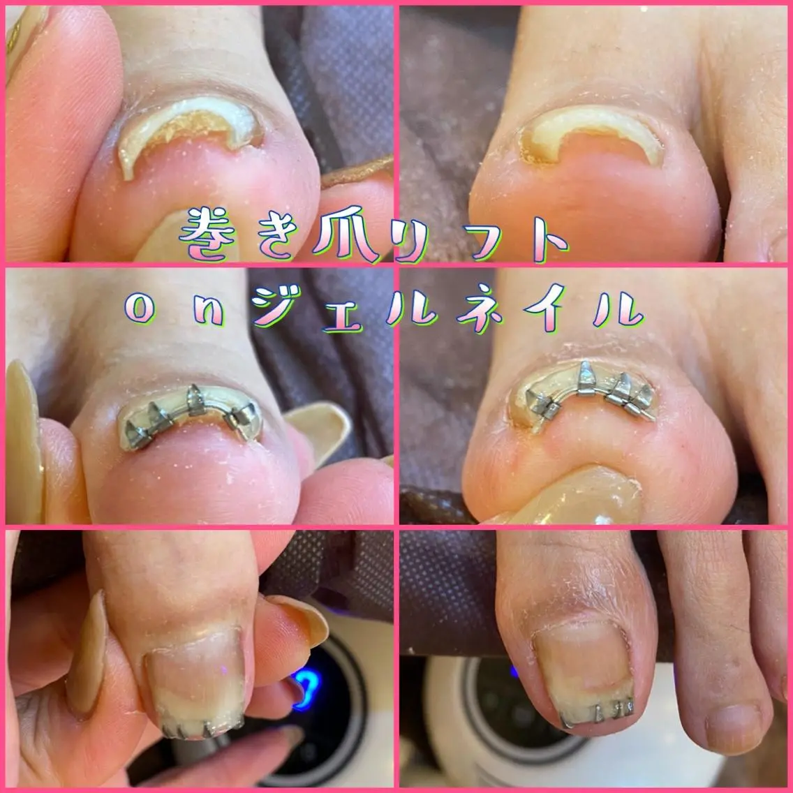 メンズ ネイル フットネイル 持ち込み 夏ネイル ♢ME2ROOM♢ #巻き爪#リラクのネイルデザイン