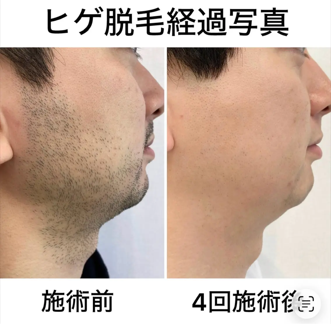 【メンズの垢抜けメニュー】髭脱毛×眉スタイリングWAX 13200円⇒6600円の写真