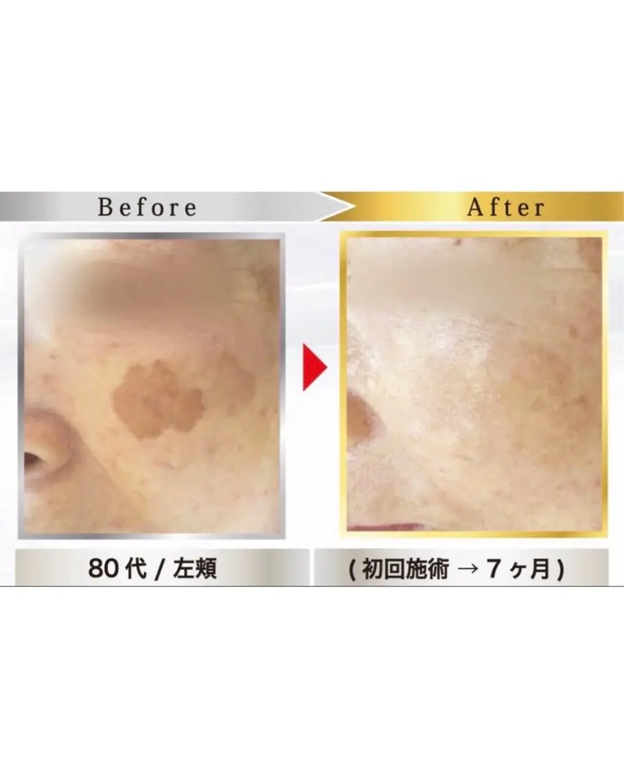 地域No.1👑本気のシミケア放題✨デコルテマッサージ付きの写真