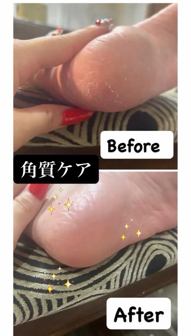 足の角質ケア🦶🏻✨️の写真
