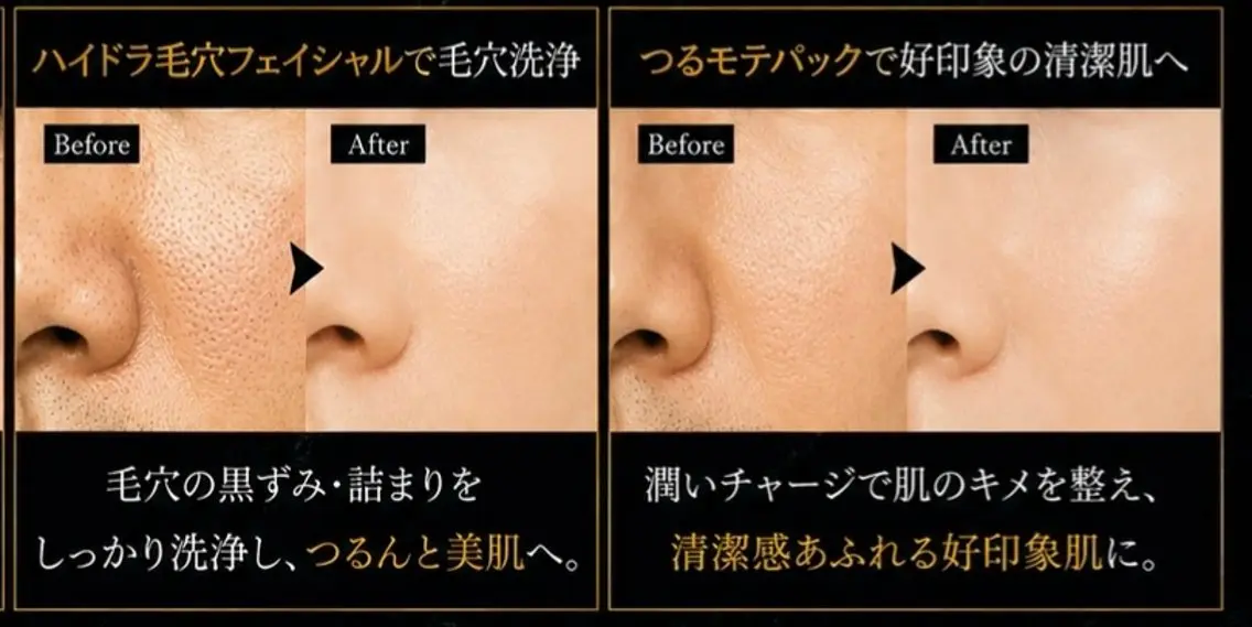 ハイドラ毛穴フェイシャル＋つるモテパックの写真