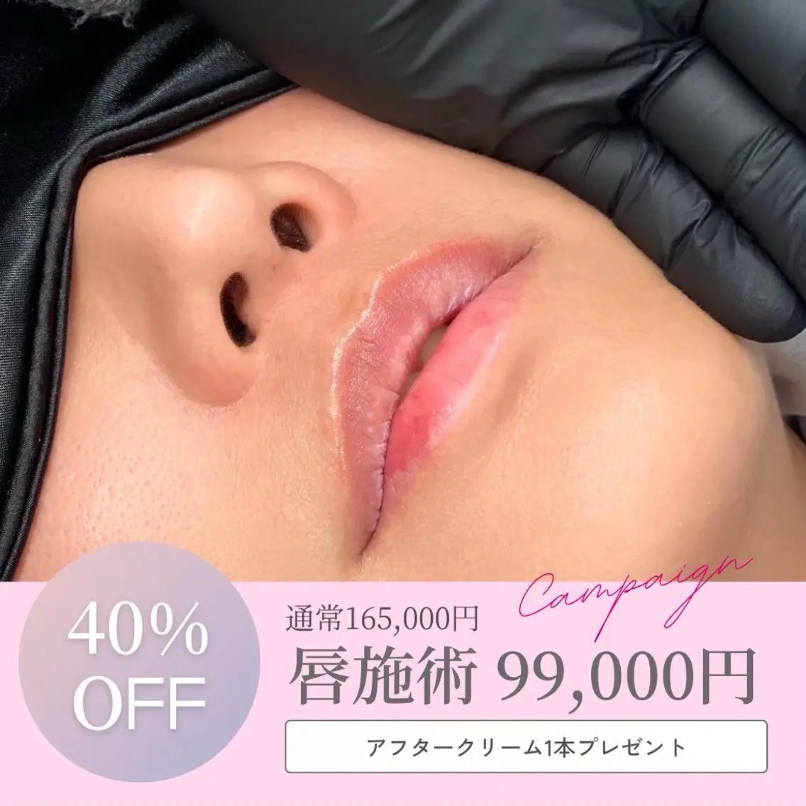 導入キャンペーン❗️ローマピンク💗唇💋《40%OFF》¥165,000→99,000🌟アフターケアクリーム付きの写真