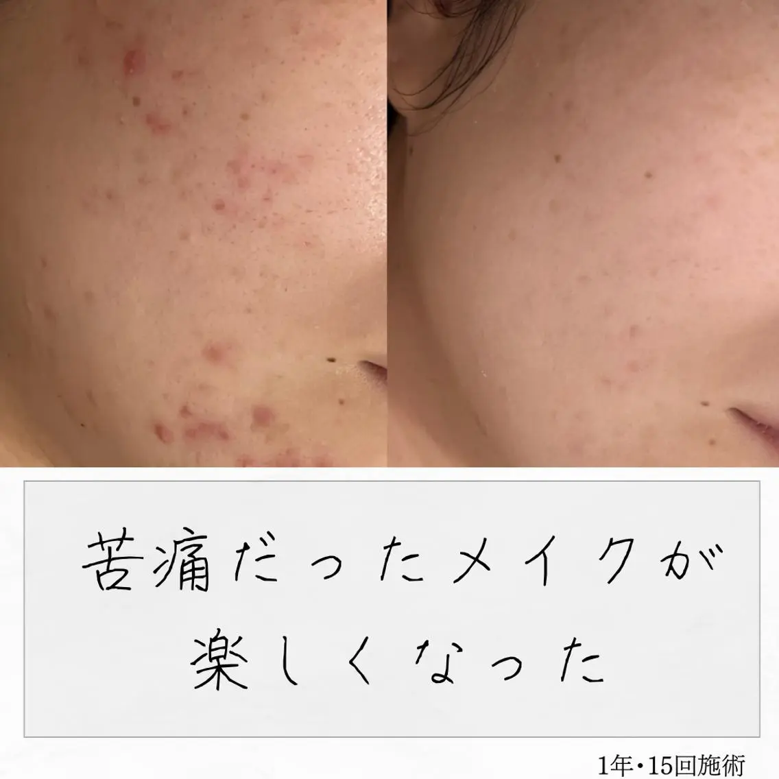 ニキビ経験者が施術 する専門サロン🌻のエステ・リラクイメージ
