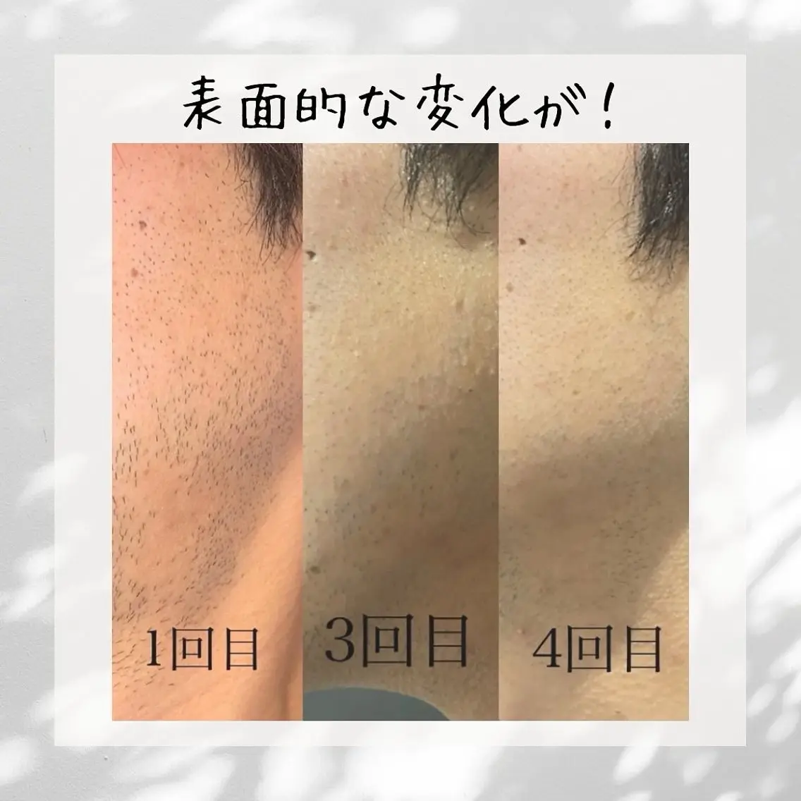【男性】ヒゲ脱毛で清潔感🥸✨の写真