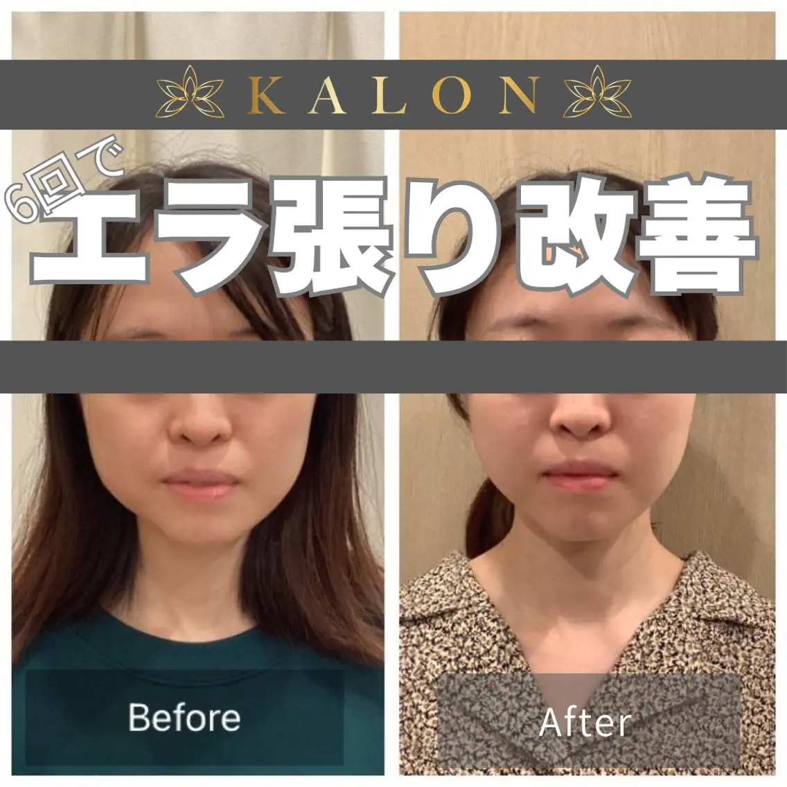 その他 美容鍼×整体 KALONのその他イメージ