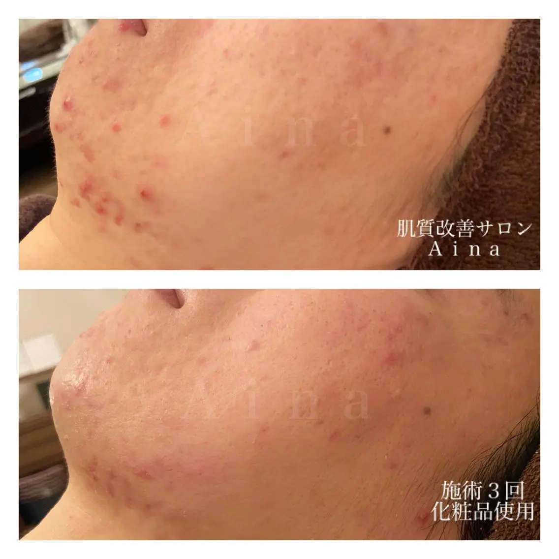 ミディアム カラー パーマ ヘアアレンジ メンズ キッズ ネイル マツエク・マツパ エステ リラク ニキビ跡専門サロン Ainaのエステ・リラクイメージ