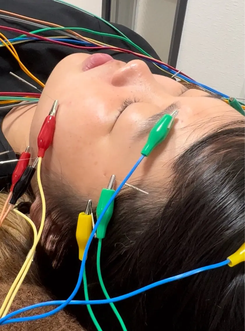 【ツヤっと美肌🧏‍♀️コース🧡】美容鍼＋ハーブピーリング🌿通常14600円➡️9500の写真