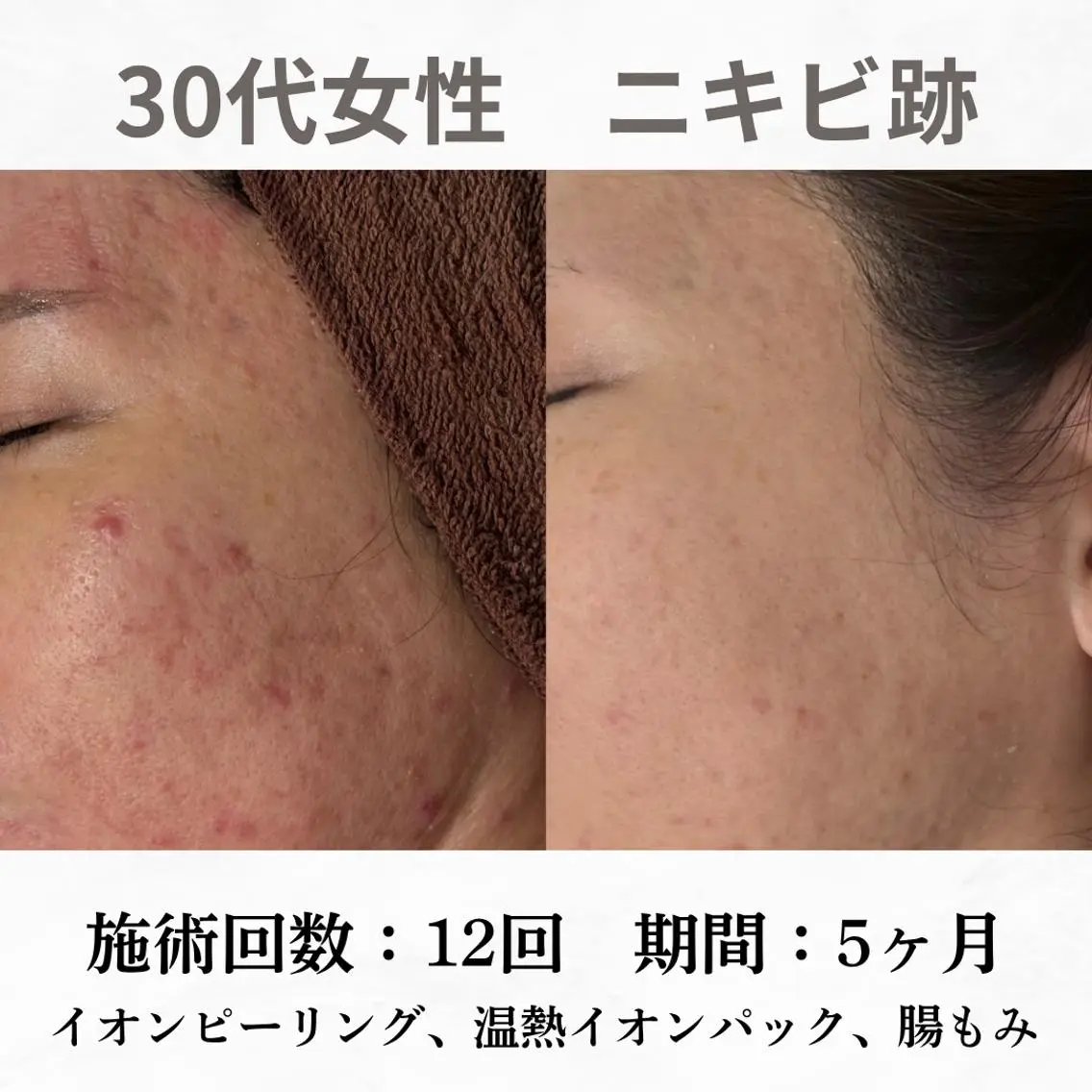 重度ニキビ専門🌷 ダウンタイムなしのエステ・リラクイメージ