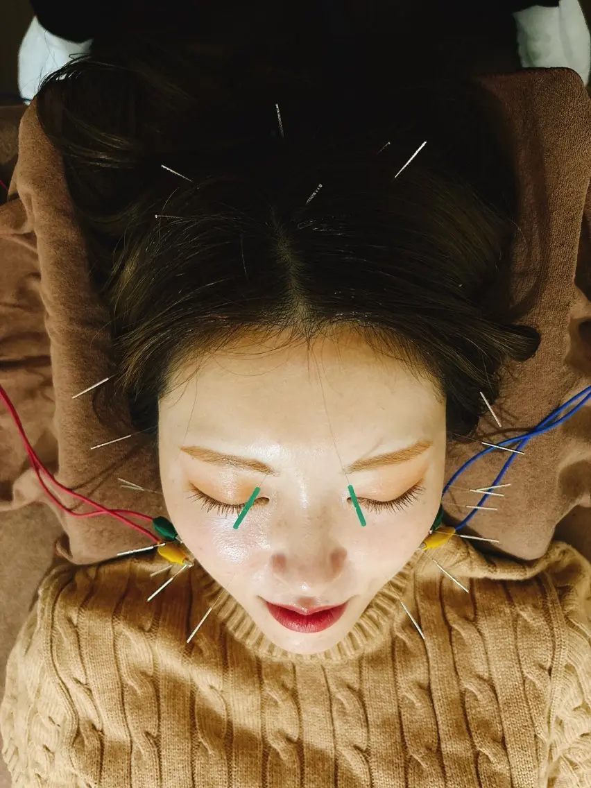 💆‍♀️美容鍼 🪡+ローラ+肩甲骨剥がし✨の写真