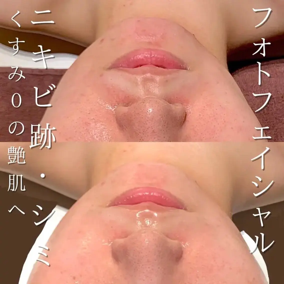 【平日限定】光フォト【ニキビ跡・シミ・たるみに◎】の写真