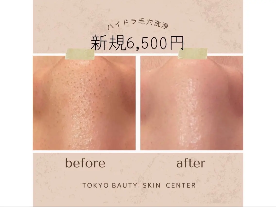 【毛穴の黒ずみ・角栓・いちご鼻が気になる方へ】ハイドラ毛穴洗浄フェイシャル+PDRN美白美容液導入潤いあふれる水光肌への写真