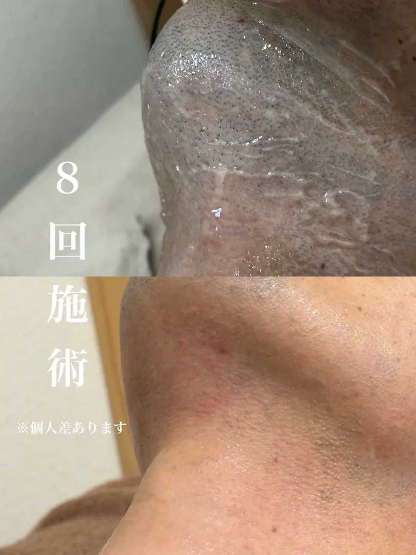 メンズヒゲ脱毛の写真