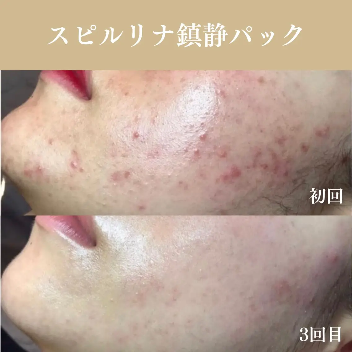 【ミニモ価格】肌荒れ鎮静ケアコース｜本気でニキビを治したい方や赤みが気になる方に🌿韓国式肌管理で肌トラブルを改善！の写真