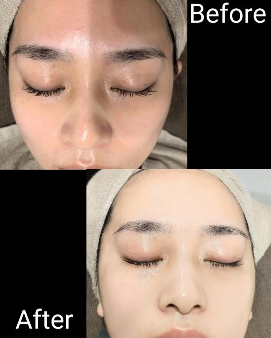 フェイシャル ベーシックWパックコース¥9500の写真