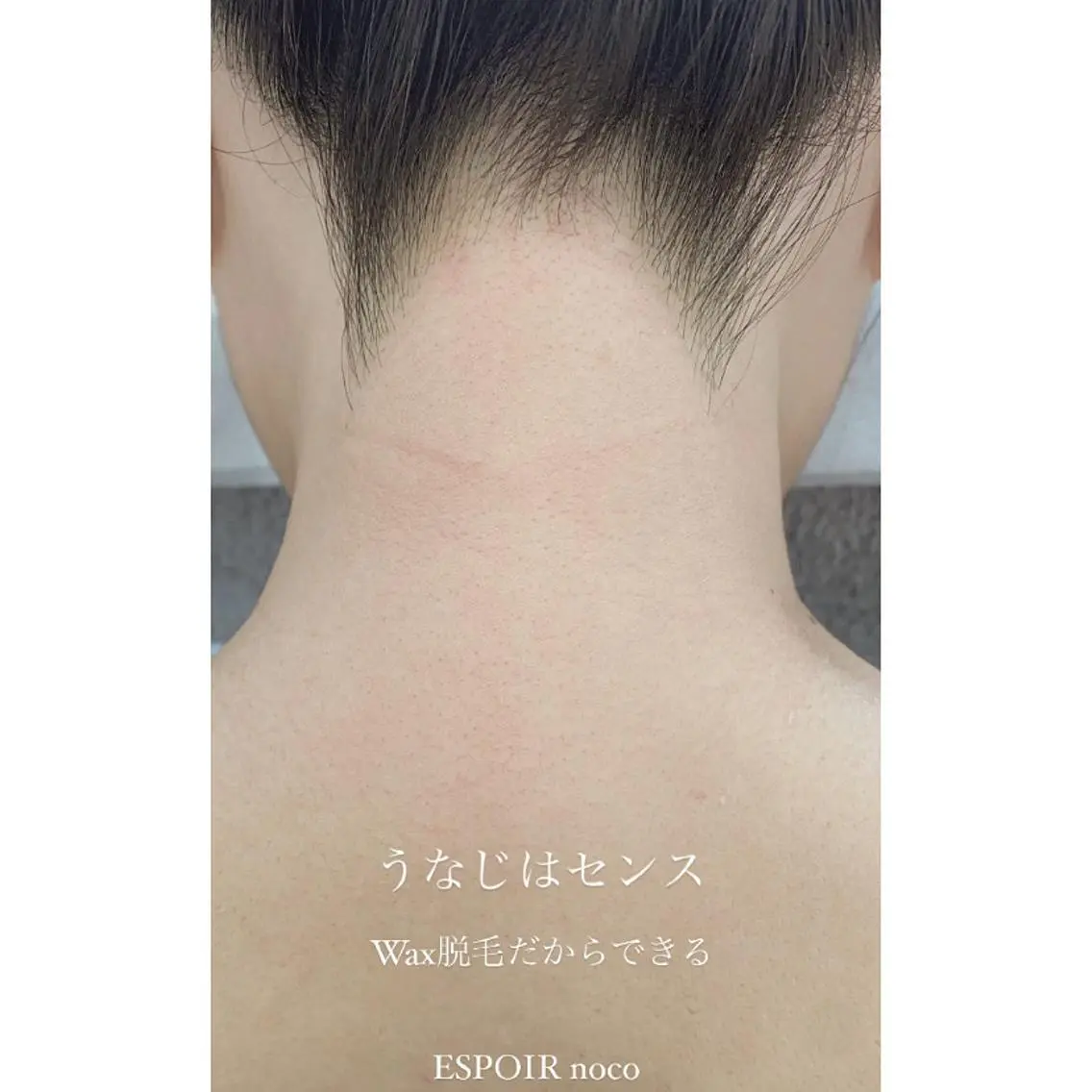 1ヶ月毛の生えないうなじ❗️本日🈳🈶うなじWax+光脱毛🌈 ダブル脱毛でうなじ美人に💛鎮静パック付きの写真
