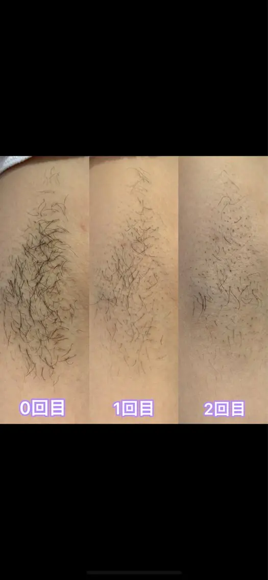 新🌸大学生の方限定‼︎脱毛デビュー応援割📣ワキ脱毛の写真